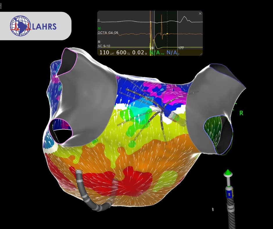 Atrial fibrillation ablation in patients with heart failure